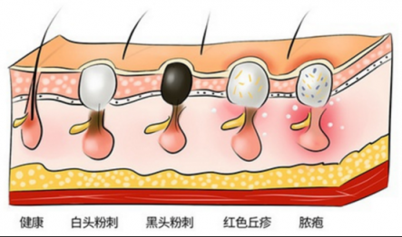 黑頭儀有用嗎？這么多款去黑頭的方法就屬它最有效