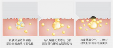 擺脫黑頭困擾，黑頭儀有用嗎？