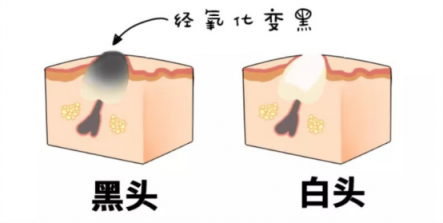 黑頭儀有用嗎？實力派去黑頭就選它！