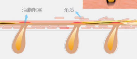 一百種去黑頭的方法都失敗了？去黑頭攻略全部拿下！