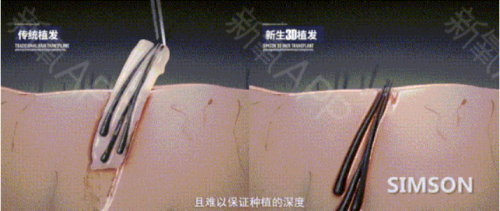 疫情下有人賺百萬，有人瀕臨倒閉，3D植發(fā)技術(shù)在行業(yè)中成“異類”