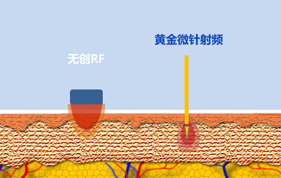 抗衰選熱瑪吉還是黃金微針？看老司機(jī)全面解讀！