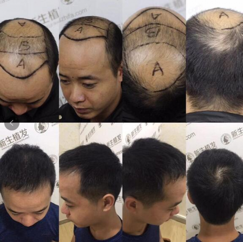 植發(fā)選對(duì)技術(shù)是關(guān)鍵 嘉興新生3D植發(fā)備受稱贊