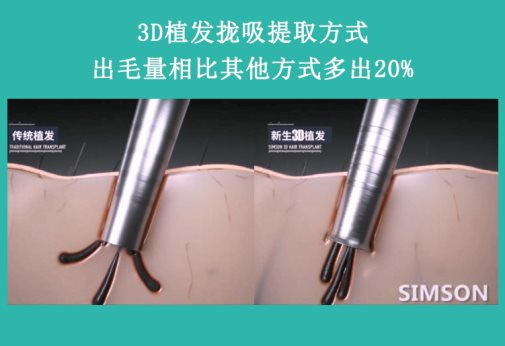 雙12熬夜搶防脫產(chǎn)品？重慶新生植發(fā)：植養(yǎng)護搭配更靠譜