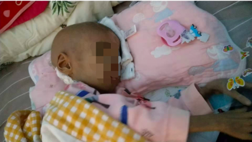4歲女童得罕見病只有11斤，高昂費(fèi)用壓垮母親，水滴愛心接力帶來希望