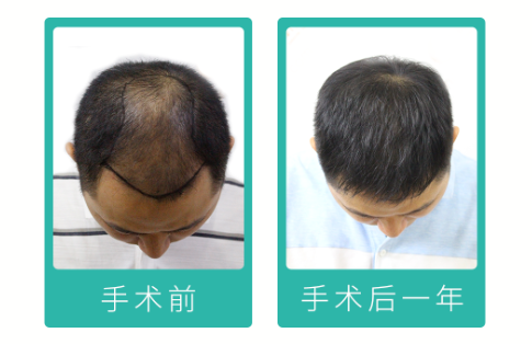 90后“禿”然崛起，常州新生植發(fā)：3D植發(fā)技術備受關注