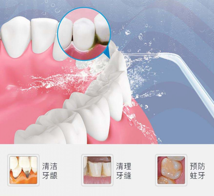 預防牙結(jié)石 XWAVES小蠻腰SE保衛(wèi)口腔健康