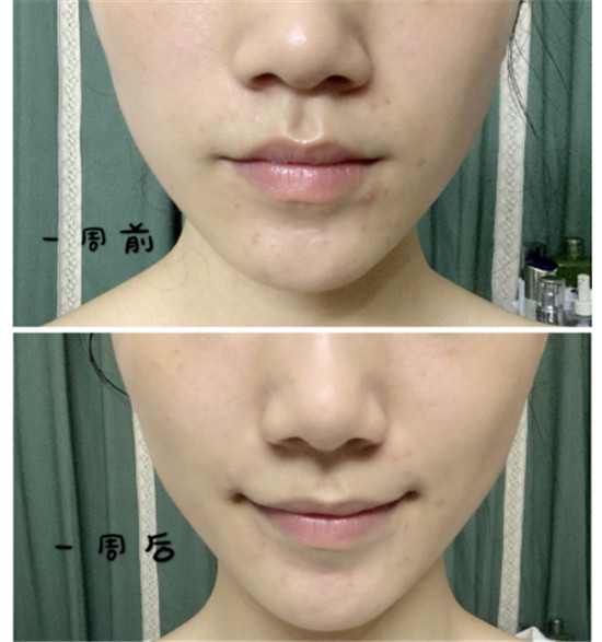 抗糖化能祛痘？HFP肌肽原液開(kāi)箱使用一周真實(shí)效果測(cè)評(píng)
