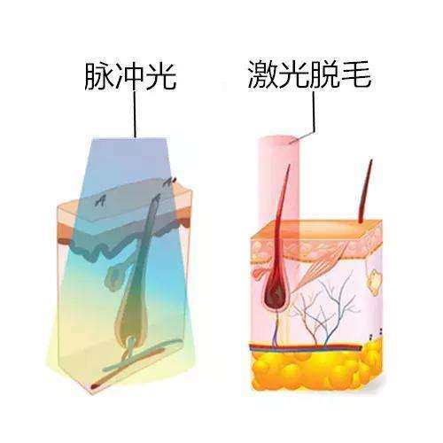 關于脫毛的這些真相，你都了解過嗎？